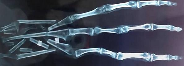 秘魯發現神秘三指手掌 疑似外星人