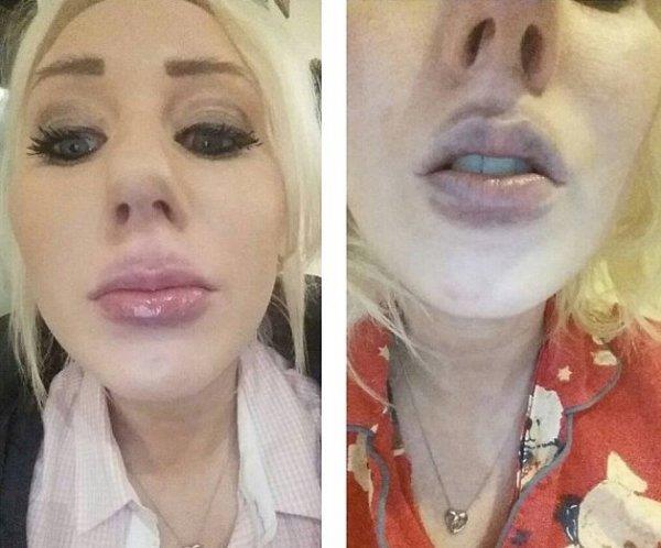 想豐唇又不想花錢 瞎折騰差點玩壞嘴唇